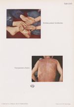 Keratoma palmare hereditarium / Psorospermosis (Darier) - Atlas der Hautkrankheiten