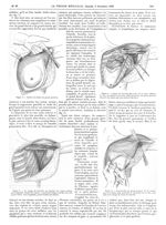 Figure 3. Section du tendon du grand pectoral / Figure 4. Curage de l'aisselle. Dissection de la vei [...]