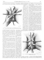 Fig. 1. Dissection de deux lambeaux scrotaux à bases adjacentes sur le raphé / Fig. 2. La dissection [...]