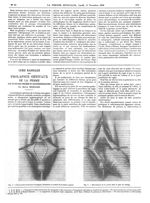 Fig. 1. Colporraphie antérieure losangique. Dissection et excision du lambeau vaginal / Fig. 2. Déco [...]