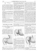 Fig. 1. La section de la séro-musculaire / Fig. 2. La dissection de la muqueuse / Fig. 3. La muqueus [...]