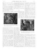 Fig. 4. Cavités droites / Fig. 5. Cavités droites (après dissection) - La Presse médicale - [Article [...]
