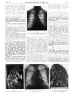 Fig. 6. Dilatation de l'artère pulmonaire et de la branche droite. Aorte petite : contrôle anatomiqu [...]