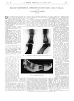 Fig. 1. Radiographie face et profil de l'articulation métatarso-phalangienne gauche / Fig. 2. Dissec [...]