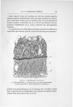 Fig. 12. Epithélioma de la mâchoire - Exposé des travaux