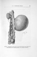 Fig. 20. Pyonéphrose expérimentale (4 mois après l'injection dans l'uretère d'une culture atténuée d [...]