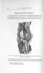 Fig. 21. Néphrite tuberculeuse ascendante par injection du bacille de Koch dans l'uretère. (Inédite) [...]
