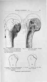 Fig. 5. Fracture de l'extrémité supérieure de l'humérus avec affaissement et rotation en arrière de  [...]