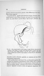 Fig. 18. Foie abaissé jusqu'à la crête iliaque - Concours pour l'agrégation, section de chirurgie et [...]