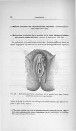 Fig. 23. Molluscum pendulum cylindrique de la grande lèvre (faux hermaphrodisme par pseudo-verge lat [...]