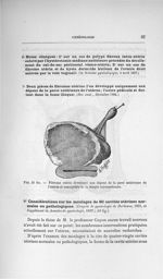 Fig. 23 bis. Fibrome utérin développé aux dépens de la paroi antérieure de l'utérus et susceptible d [...]