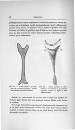 Fig. 24. Cornes utérines asymétriques, en «ailes de papillon». Utérus sans lésions (grandeur naturel [...]