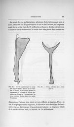 Fig. 26. Cavité asymétrique du corps par rapport à l'axe du col et de l'isthme / Fig. 27. Cornes uté [...]