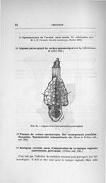 Fig. 30. Lipome du cordon spermatique paravaginal - Concours pour l'agrégation, section de chirurgie [...]