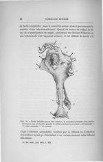 Fig. 10. Vessie infectée par sa face externe - Concours pour l'agrégation, section de chirurgie et d [...]