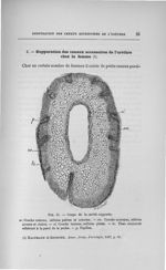 Fig. 11. Coupe de la cavité suppurée - Concours pour l'agrégation, section de chirurgie et d'accouch [...]