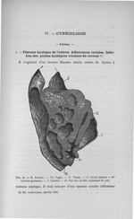 Fig. 12. R, Rectum. - Va. Vagin. - V. Vessie. - C. Cavité utérine. - Gr Lobules graisseux. - I. Inte [...]