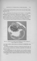 Fig. 15. Pavillon de la trompe ouvert à l'intérieur d'un kyste enflammé de l'ovaire. (Dessin de H. B [...]