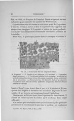 Fig. 17. Gonocoques dans une coupe de la trompe - Concours pour l'agrégation, section de chirurgie e [...]