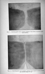 Fig. 3. Endodiagraphie de la symphyse pubienne d'une femme accouchée depuis trois semaines / Fig. 4. [...]