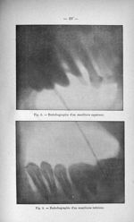 Fig. 8. Endodiagraphie d'un maxillaire supérieur / Fig. 9. Endodiagraphie d'un maxillaire inférieur  [...]