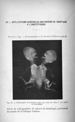 Fig. 10. Radiographie d'un monstre triple, qui avait été classé à tort parmi les xyphopages - Titres [...]