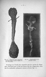 Fig. 11. Aspect du foetus papyraceus enveloppé dans sa gaine et ayant l'aspect d'un caillot / Fig. 1 [...]