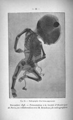 Fig. 13. Radiographie d'un foetus papyraceus - Titres scientifiques du Dr L. Bouchacourt, agrégation [...]