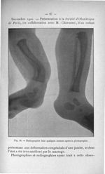 Fig. 18. Radiographie faite quelques instants après la photographie - Titres scientifiques du Dr L.  [...]