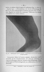 Fig. 19. Radiographie après le massage ; la déformation est en voie de correction presque parfaite - [...]