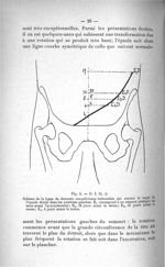 Fig. 3. O. I. G. A. Schéma de la ligne de descente sus-pelvienne hélicoïdale qui montre le trajet de [...]