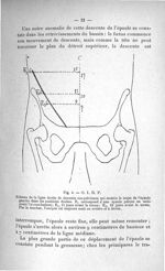 Fig. 4. O. I. D. P. Schéma de la ligne droite de descente sus-pelvienne qui montre le trajet de l'ép [...]