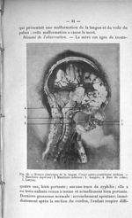 Fig. 12. Ectopie pharyngée de la langue - Titres et travaux scientifiques du Dr Fabre, agrégation de [...]