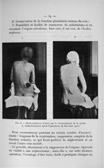 Fig. 8. Hydronéphrose traitée par le retournement de la poche - Concours d'agrégation de chirurgie e [...]