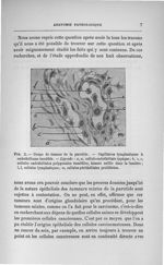 Fig. 2. Coupe de tumeur de la parotide - Concours d'agrégation de chirurgie et d'accouchements, 1901 [...]