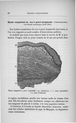 Kyste congénital à paroi lymphoïde - Concours d'agrégation de chirurgie et d'accouchements, 1901, ex [...]