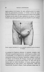Hernie inguino-interstitielle - Concours d'agrégation de chirurgie et d'accouchements, 1901, exposé  [...]