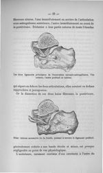 Les deux ligaments principaux de l'excavation calcanéo-astragalienne, l'un externe, l'autre profond  [...]