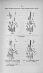 Fig. 1. Fig. 2. Anastomose oblique ou transversale entre la br. dorsale et le collatéral interne du  [...]
