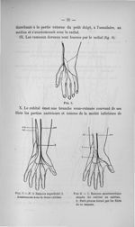 Fig. 6 / Fig. 7. N.S. Rameau superficiel. 1. Anastomose avec le tronc cubital / Fig. 8. 1. Rameau an [...]