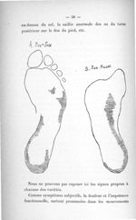 A. Pied sain / B. Pied malade - Concours pour l'agrégation, 1901, section de pathologie externe et d [...]
