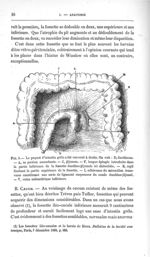 Fig. 8. Le paquet d'intestin grêle a été renversé à droite - Concours pour l'agrégation, section de  [...]
