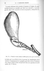 Fig. 17. Vésicule et canal cystique, insufflés puis ouverts après dossiccation - Concours pour l'agr [...]