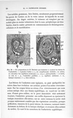 Fig. 26. Ces préparations de M. Toupet sont destinées à montrer les lésions de l'endartérite - Conco [...]