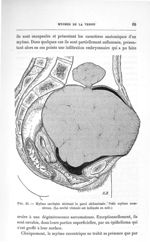 Fig. 29. Myôme cavitaire ulcérant la paroi abdominale - Concours pour l'agrégation, section de chiru [...]