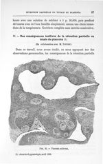 Fig. 33. Placenta scléreux - Concours pour l'agrégation, section de chirurgie et d'accouchements. Ex [...]
