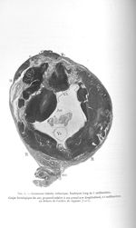 Fig. 4. Grossesse tubaire isthmique. Embryon long de 5 millimètres - Exposé des travaux