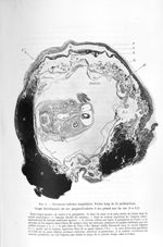 Fig. 6. Grossesse tubaire ampullaire. Foetus long de 35 millimètres - Exposé des travaux