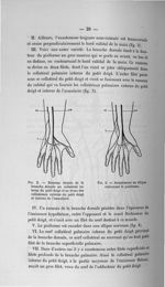 Fig. 3. Rameau étendu de la branche dorsale au collatéral interne du petit doigt et au tronc des col [...]
