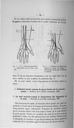Fig. 7. N. S. Rameau superficiel. 1. Anastomose avec le tronc cubital / Fig. 8. 1. Rameau anastomoti [...]